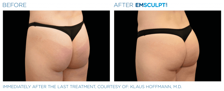 EMSCULPT NEO Before & After | Body Contouring