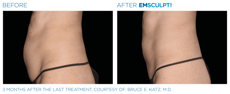 EMSCULPT NEO Before & After | Body Contouring