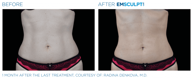 EMSCULPT NEO Before & After | Body Contouring