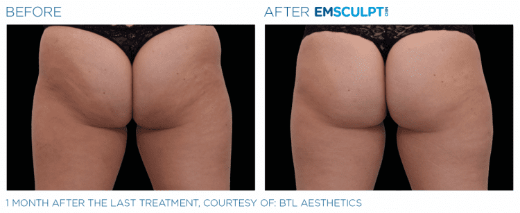 EMSCULPT NEO Before & After | Body Contouring