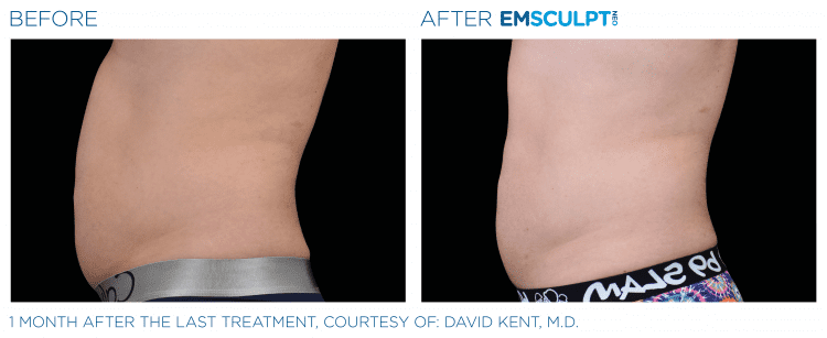 EMSCULPT NEO Before & After | Body Contouring