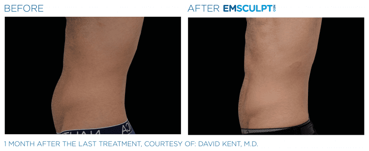 EMSCULPT NEO Before & After | Body Contouring