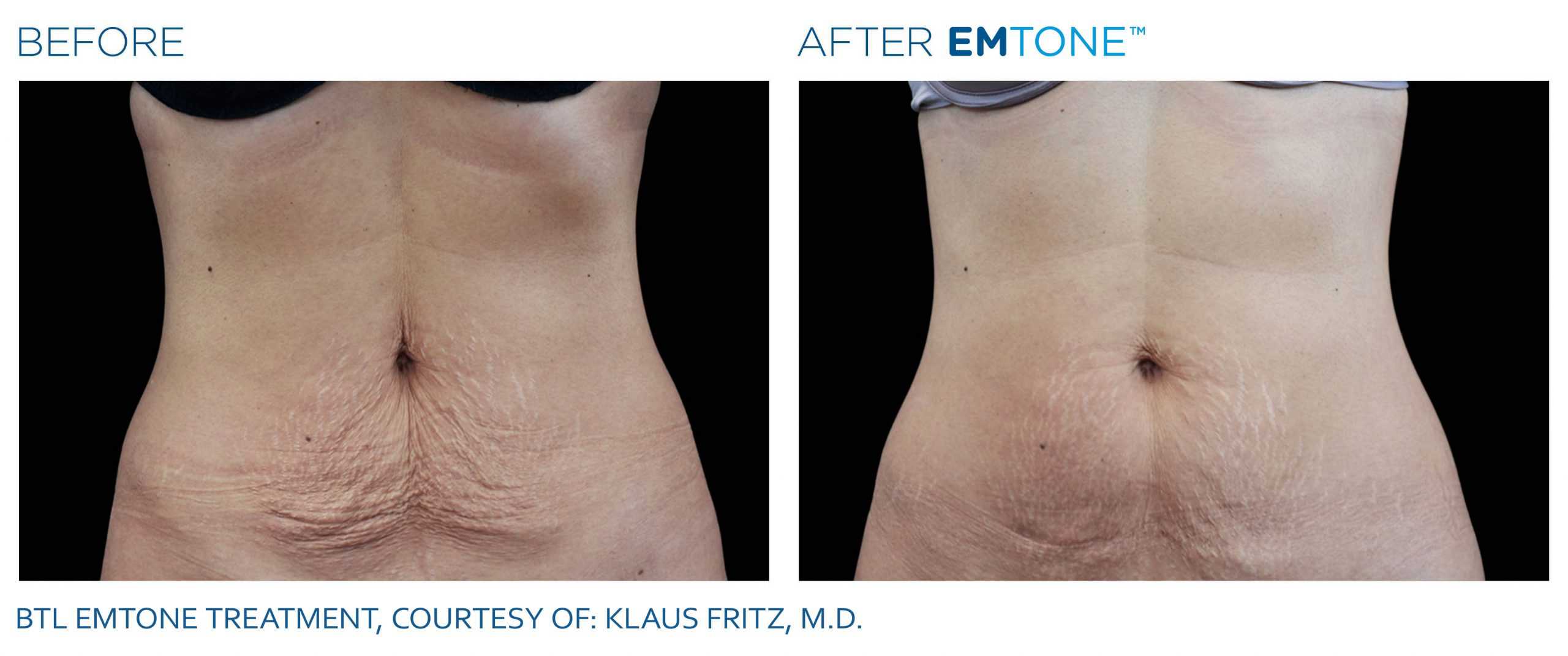 EMTONE Before & After | Cellulite Reduction