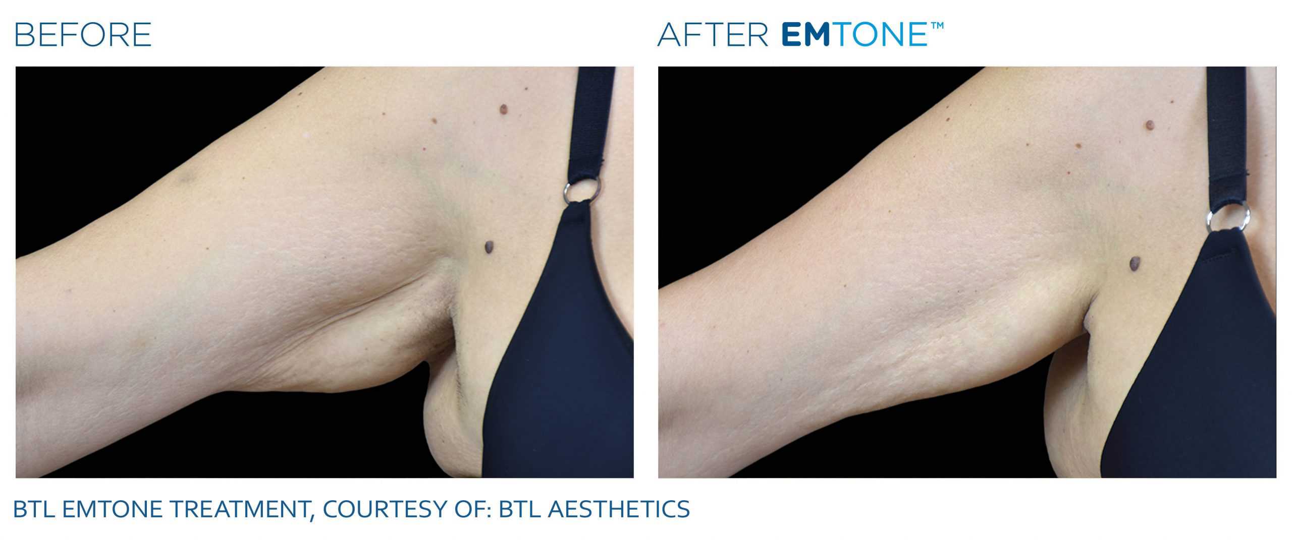 EMTONE Before & After | Cellulite Reduction