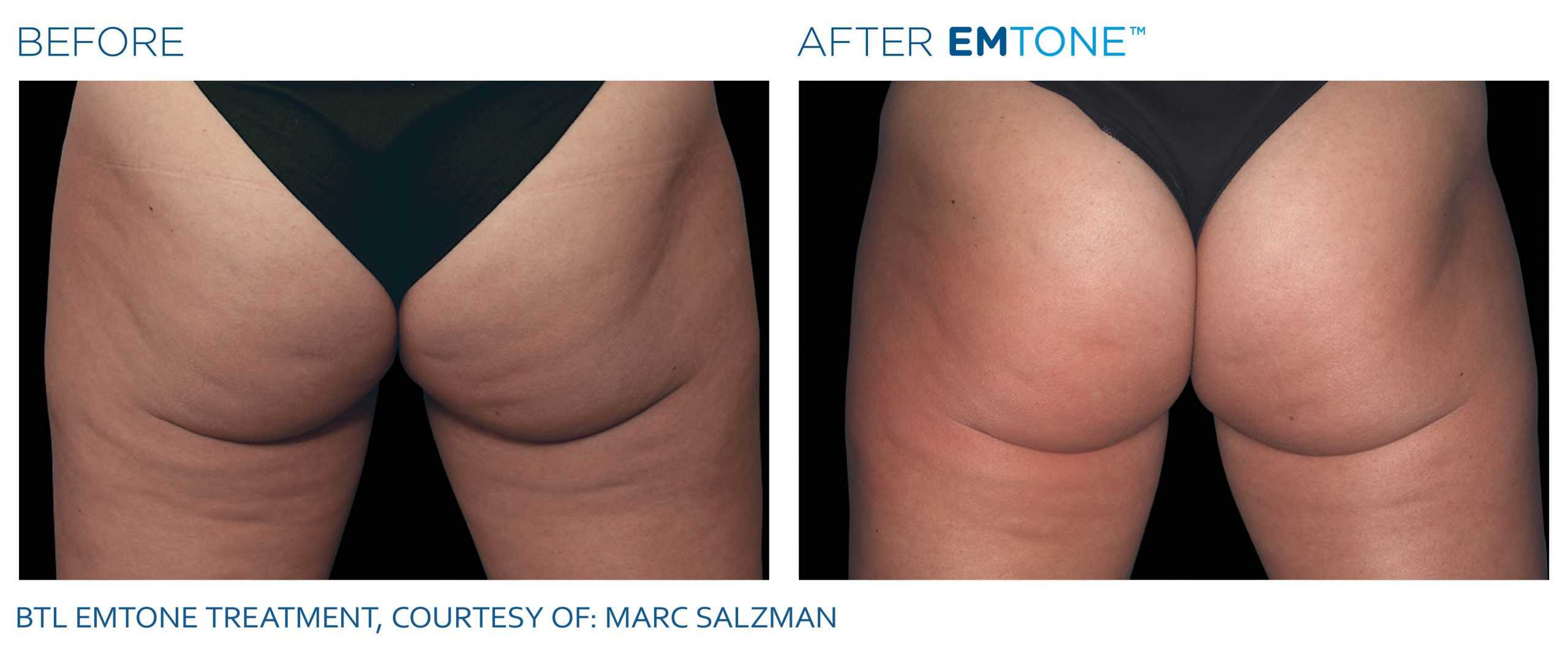 EMTONE Before & After | Cellulite Reduction