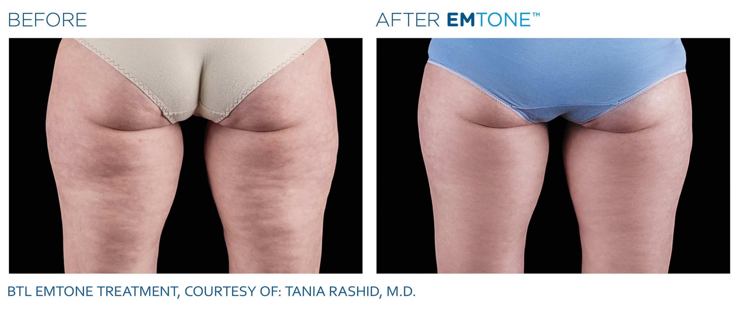 EMTONE Before & After | Cellulite Reduction