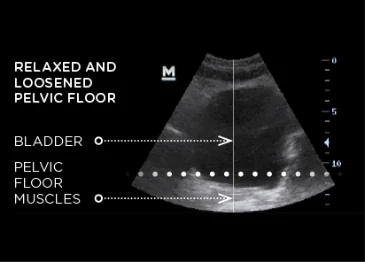 EMSELLA Before & After | URINARY INCONTINENCE